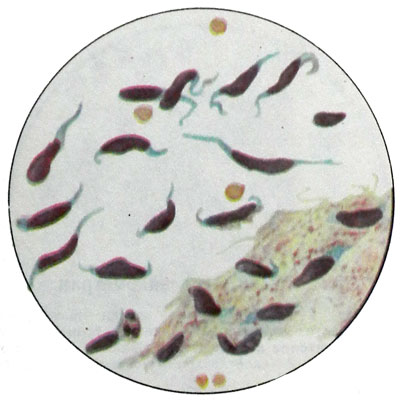 Лейомиофиброма - фибромиома матки - скопление фиброцитов