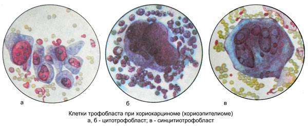 Клетки трофобласта при хориокарциноме