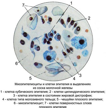 Миоэпителиоциты и клетки эпителия в выделениях из соска молочной железы