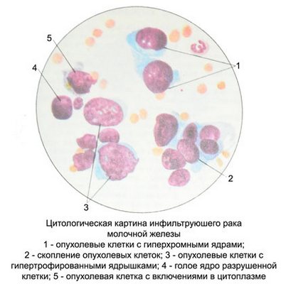 Цитологическая картина инфильтрующего рака молочной железы