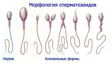 Сперматозоиды - нормальный и ненормальный вид