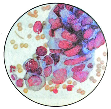 Эмбриональный рак яичка - цитологическая картина