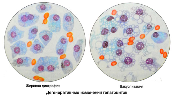 Дегенеративные изменения гепатоцитов