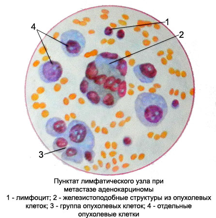 Метастазы аденокарциномы - пунктат лимфатического узла