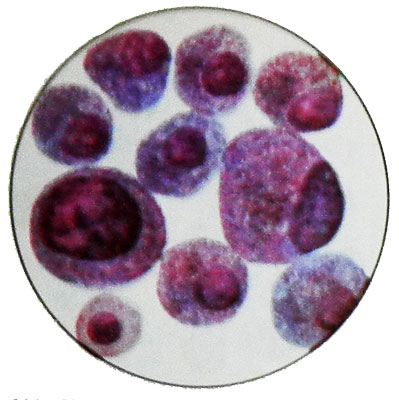 Аденома из В-клеток (клеток Асканази) с малигнизацией