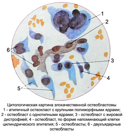 Цитологическая картина злокачественной остеобластомы