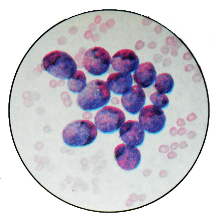Перстневидно-клеточный рак желудка - Цитологическая картина