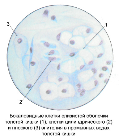 Бокаловидные клетки слизистой оболочки толстой кишки, клетки цилиндрического и плоского эпителия в промывных водах толстой кишки
