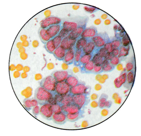 Высокодифференцированная аденокарцинома кишок - Цитологическая картина