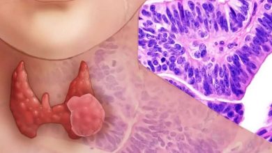 甲状腺腫: 特徴的な点状甲状腺 - 甲状腺癌