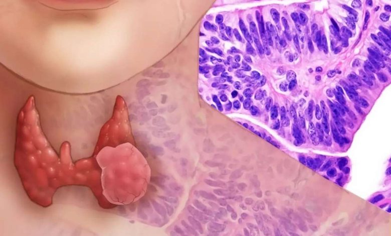Щитовидната жлеза аденом: характерен пунктата щитовидната - Рак на щитовидната жлеза
