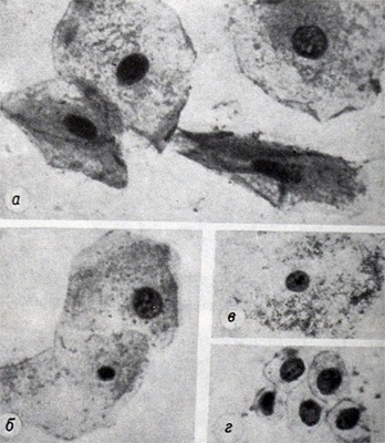 Большие метаплазированные клетки в мокроте - метаплазия эпителия бронхов