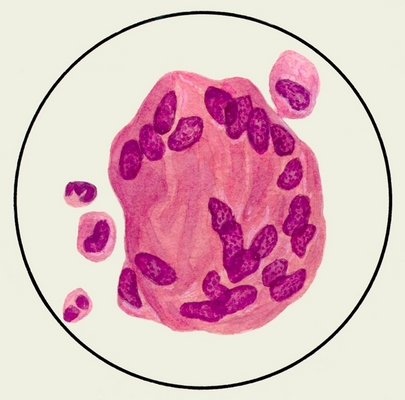 Многоядерные клетки Пирогова—Лангханса