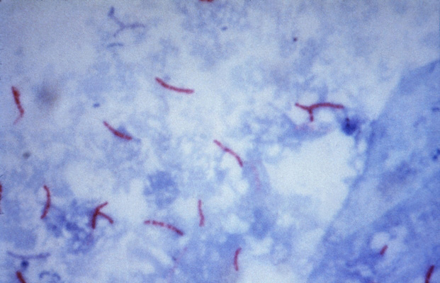 Микробактерии туберкулеза в мокроте при окраске по Цилю-Нельсену