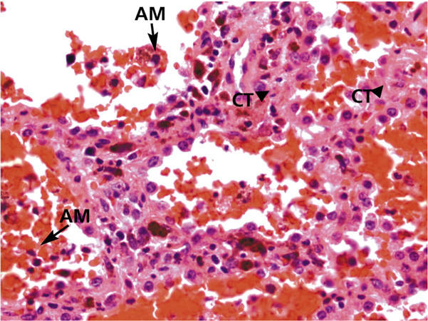 Альвеолярные макрофаги, содержащие гемосидерин или эритроциты - клетки порока сердца