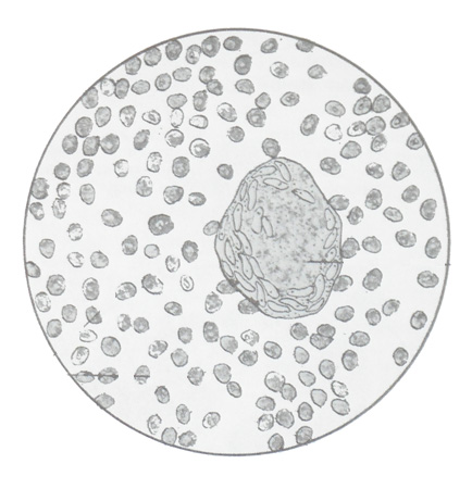 Туберкулез мочевого пузыря - клетки в моче
