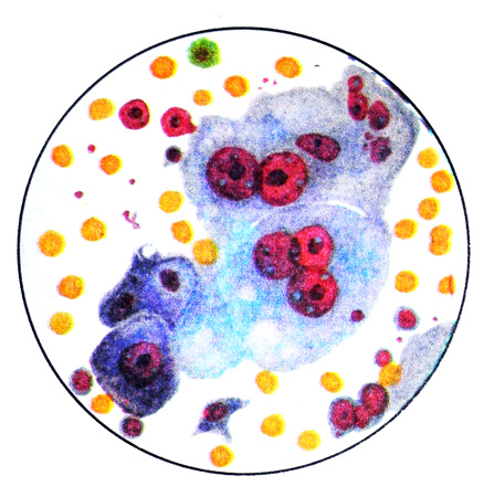 Светлоклеточный рак - цитологическая картина