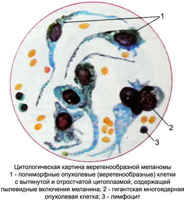 Цитологическая картина веретенообразной меланомы