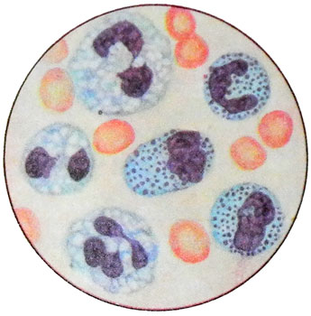 Токсогенная зернистость и вакуолизация нейтрофильных гранулоцитов