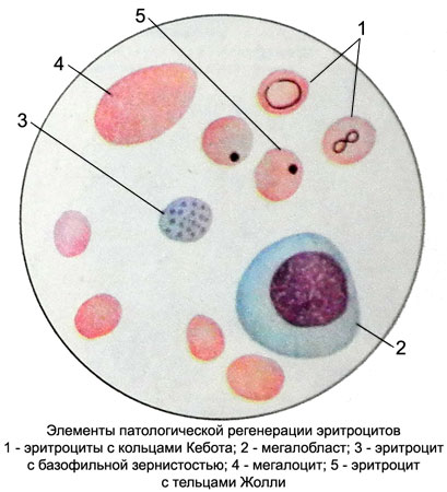 Эритроциты – Элементы патологической регенерации - Тельца Жолли, кольца Кебота, базофильная зернистость