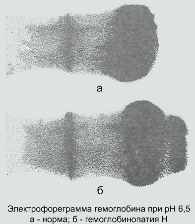 Электрофореграмма гемоглобина в норме и гемоглобинопатии Н при рН 6,5