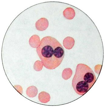 Эритроциты при дизэритропоэтической анемии II типа