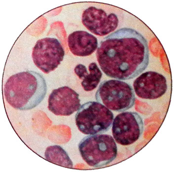 Острый миелобластный лейкоз - картина крови