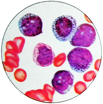 Острый промиелоцитарный лейкоз - цитологическая картина крови