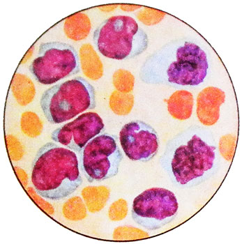 Острый монобластный лейкоз - картина периферической крови