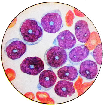 Острый лимфобластный лейкоз - картина периферической крови
