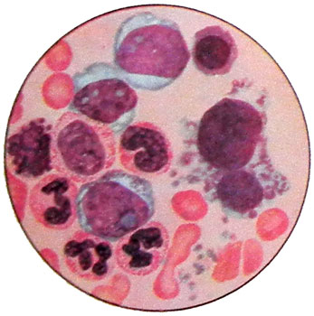 Картина периферической крови хронического миелолейкоза