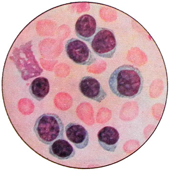 Хронический лимфолейкоз - картина периферической крови