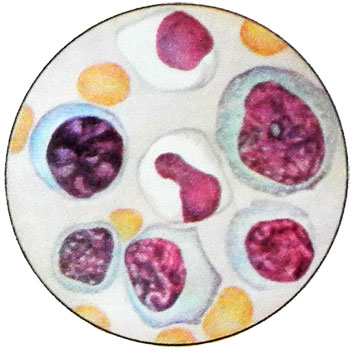 Инфекционный мононуклеоз - картина периферической крови