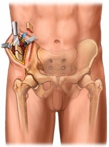 Отбор костного трансплантата из гребня подвздошной кости