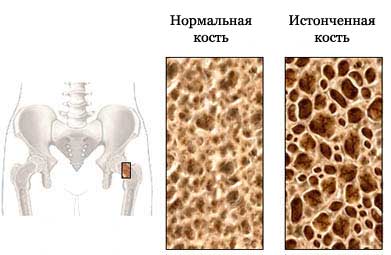 Остеопороз - Определение плотности костной ткани