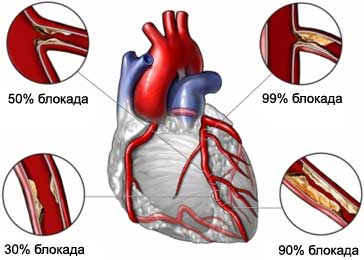 Различные степени атеросклероза в коронарных артериях
