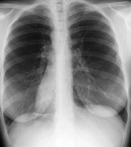 Рентген грудной клетки - Рентгенограмма грудной клетки