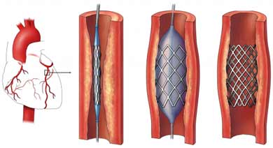Коронарное стентирование - Стентирование коронарных артерий