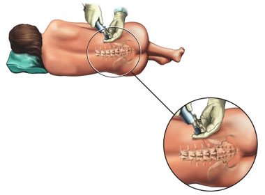 Эпидуральная инъекция стероида - Спинная инъекция кортикостероида - Спинная инъекция стероида