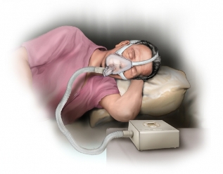 Постоянное положительное давление в дыхательных путях - СИПАП