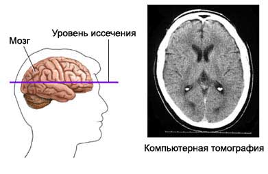 Компьютерная томография головы