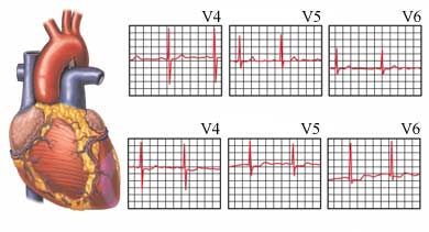 Сердечный стресс-тест - Выявление повреждения сердечной мышцы на ЭКГ