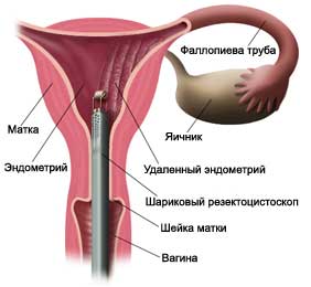 Аблация эндометрия