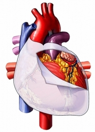 УЗИ сердца - Эхокардиограмма - Сердечный мешок