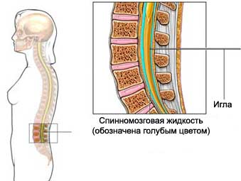 Эпидуральная пломбировка кровью - ЭПК