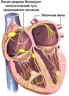 Операция на сердце "лабиринт"- линии разреза блокируют патологический путь прохождения сигналов