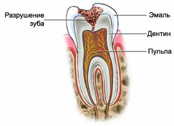 Разрушение зуба - Установка зубной коронки