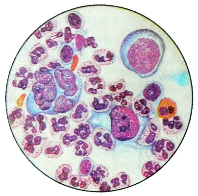 Смешанно-клеточный вариант лимфогранулематоза