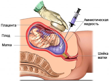 Эмбриональное переливание крови - Внутриутробное переливание крови - Интраперитонеальное переливание крови