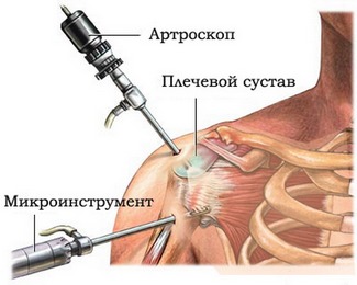 Артроскопия - процедура, проводимая чтобы визуально исследовать сустав